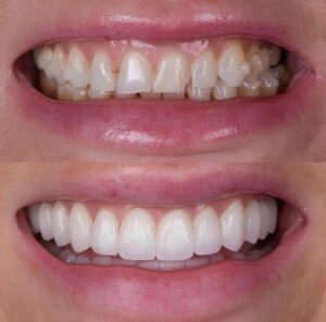 carillas para dientes torcidos