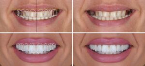 diseño digital de sonrisas