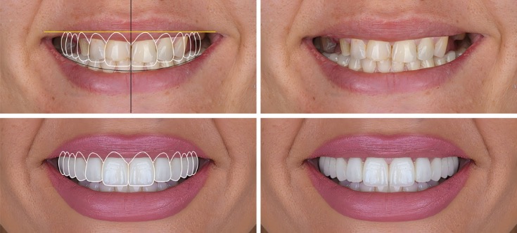 diseño digital de sonrisas