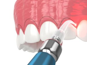 contorneado dental estetico