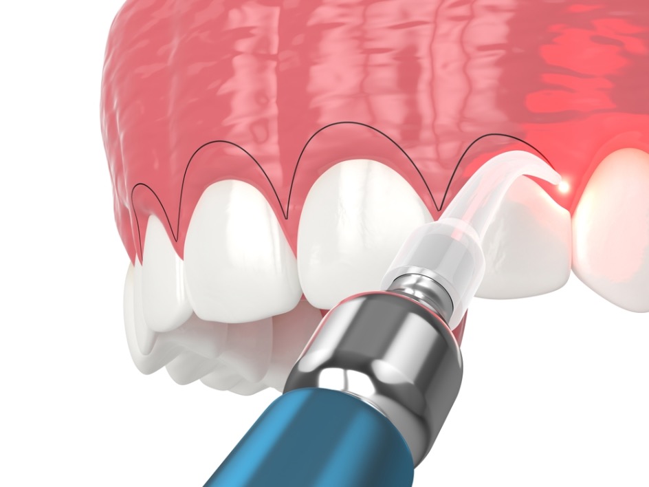 contorneado dental estetico