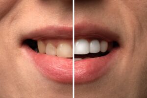 a que edad se pueden poner carillas dentales