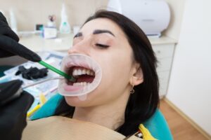 como se pone una carilla dental