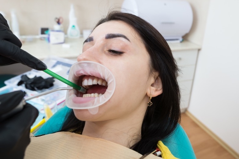 como se pone una carilla dental