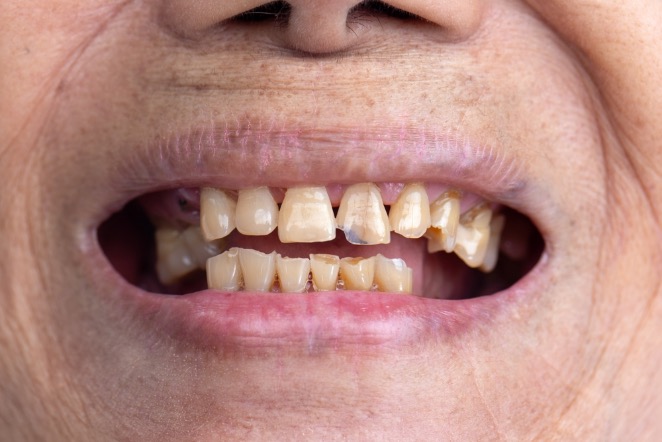 desgaste del esmalte dental
