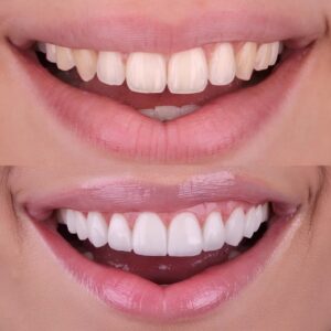 carillas dentales antes y despues