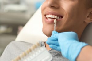 carillas en odontologia estetica