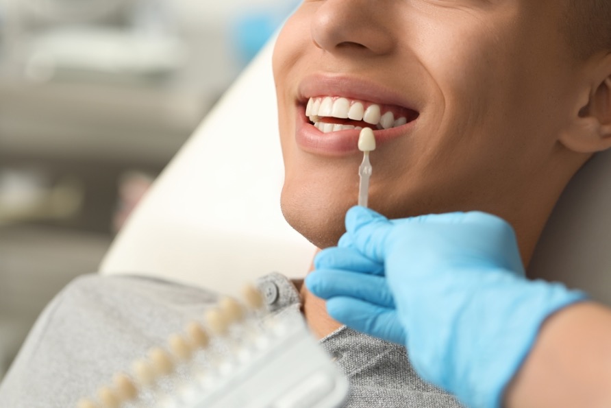 carillas en odontologia estetica