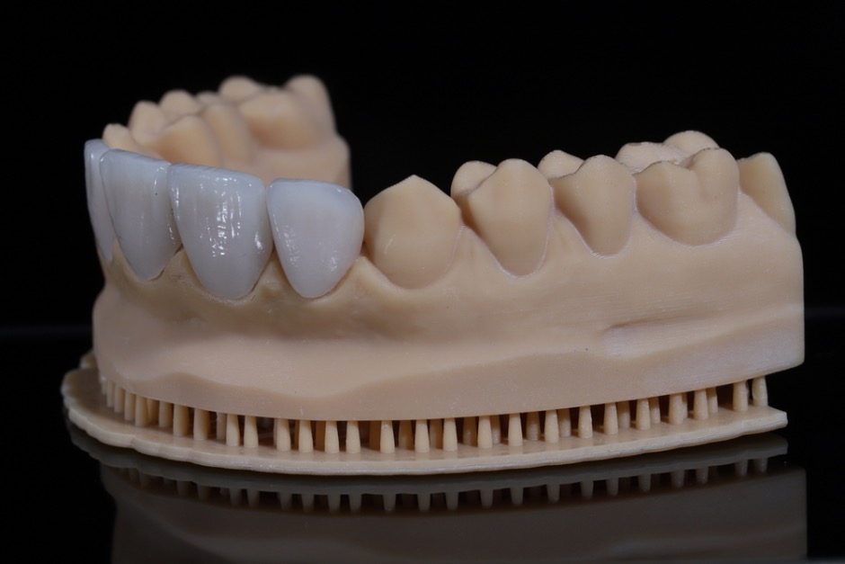 carillas de porcelana en dientes torcidos