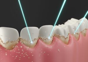 blanqueamiento dental estetico