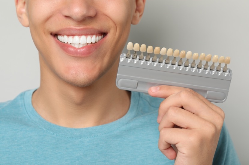 a que edad se pueden poner carillas dentales