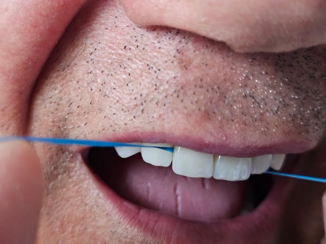 mantenimiento de carillas dentales
