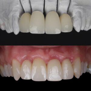 carillas de porcelana en dientes torcidos