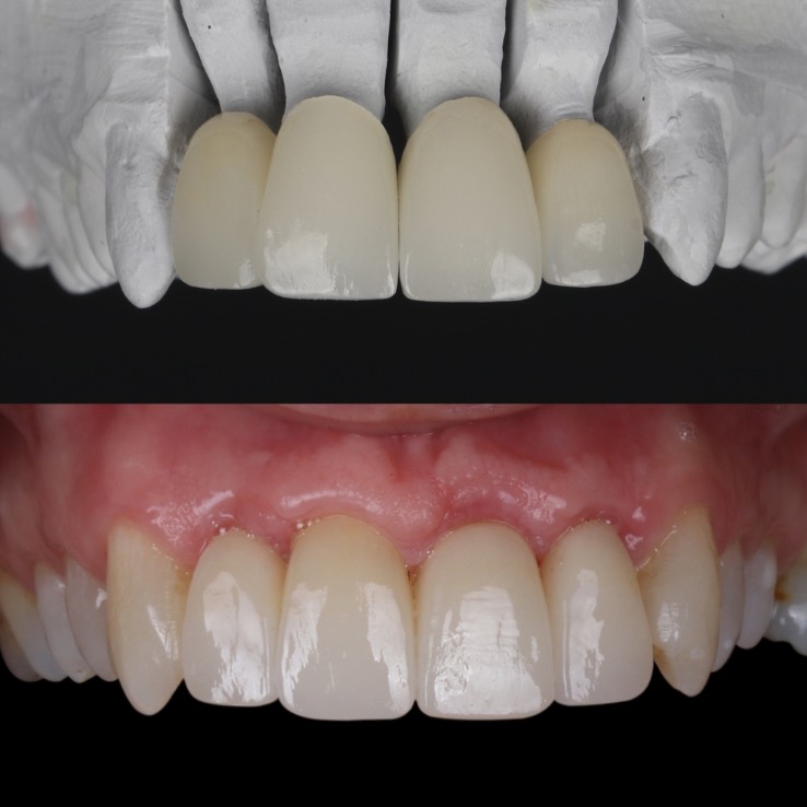 carillas de porcelana en dientes torcidos