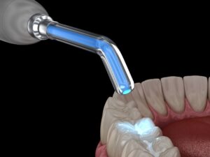 arreglos esteticos dentales