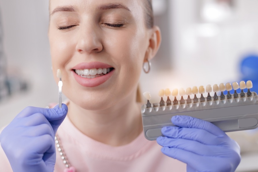 carillas dentales cuales son las mejores