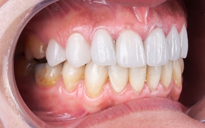 carillas de porcelana sin tallado dental