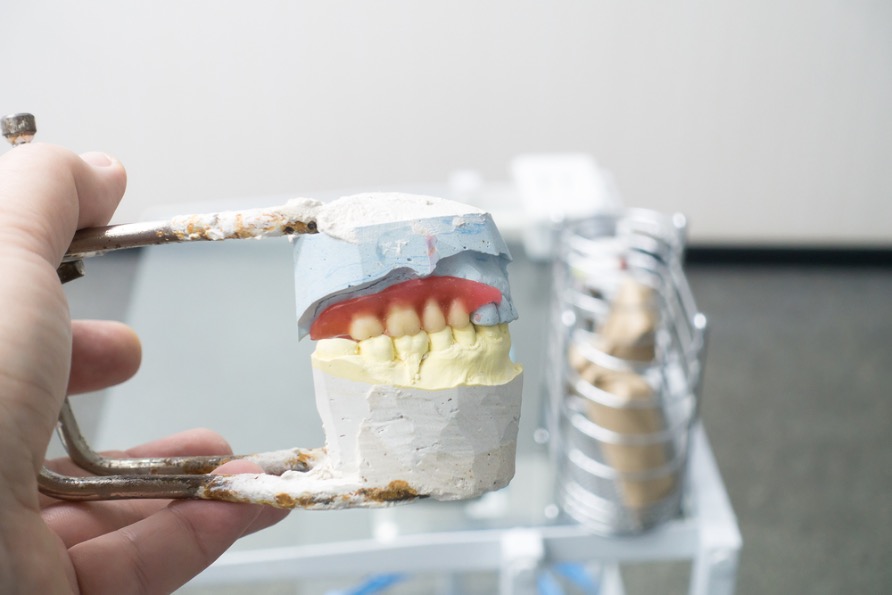 como se hacen las carillas dentales