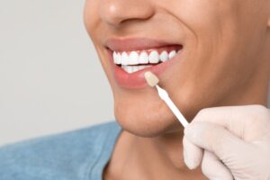 como quedan las carillas en los dientes