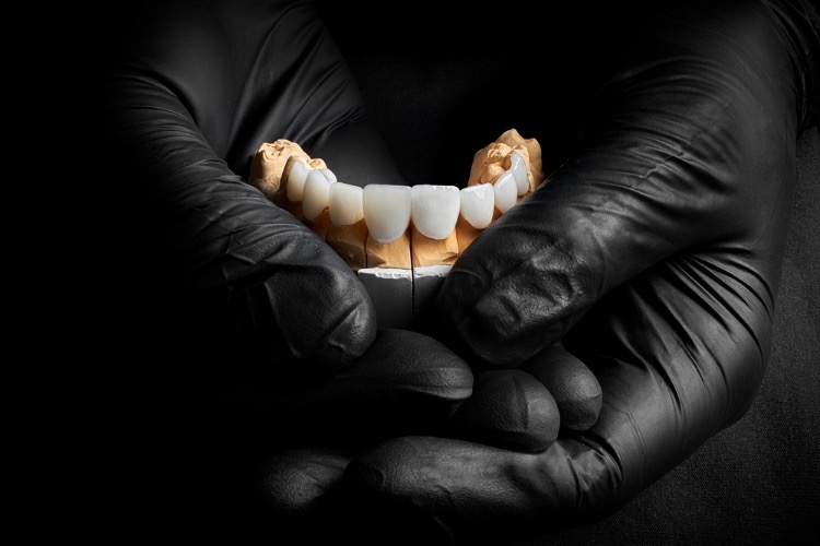 como quedan los dientes antes de las carillas