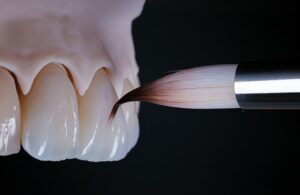 como quedan los dientes despues de quitar las carillas
