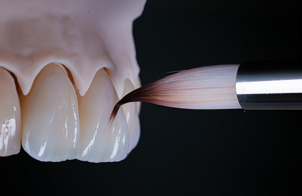 como quedan los dientes despues de quitar las carillas