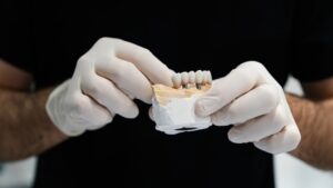 cuando no se puede poner carillas dentales