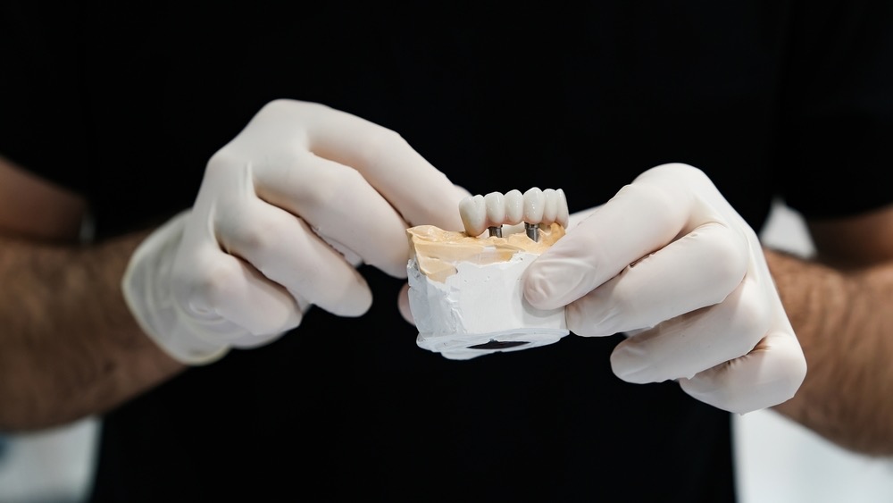 cuando no se puede poner carillas dentales