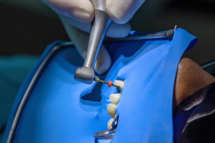 como liman los dientes para poner carillas