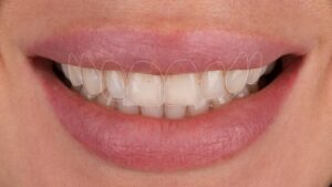 ortodoncia y diseño de sonrisa