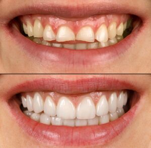 como hacen los diseños de sonrisa