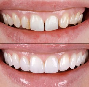 diseño de sonrisa que es y para que sirve