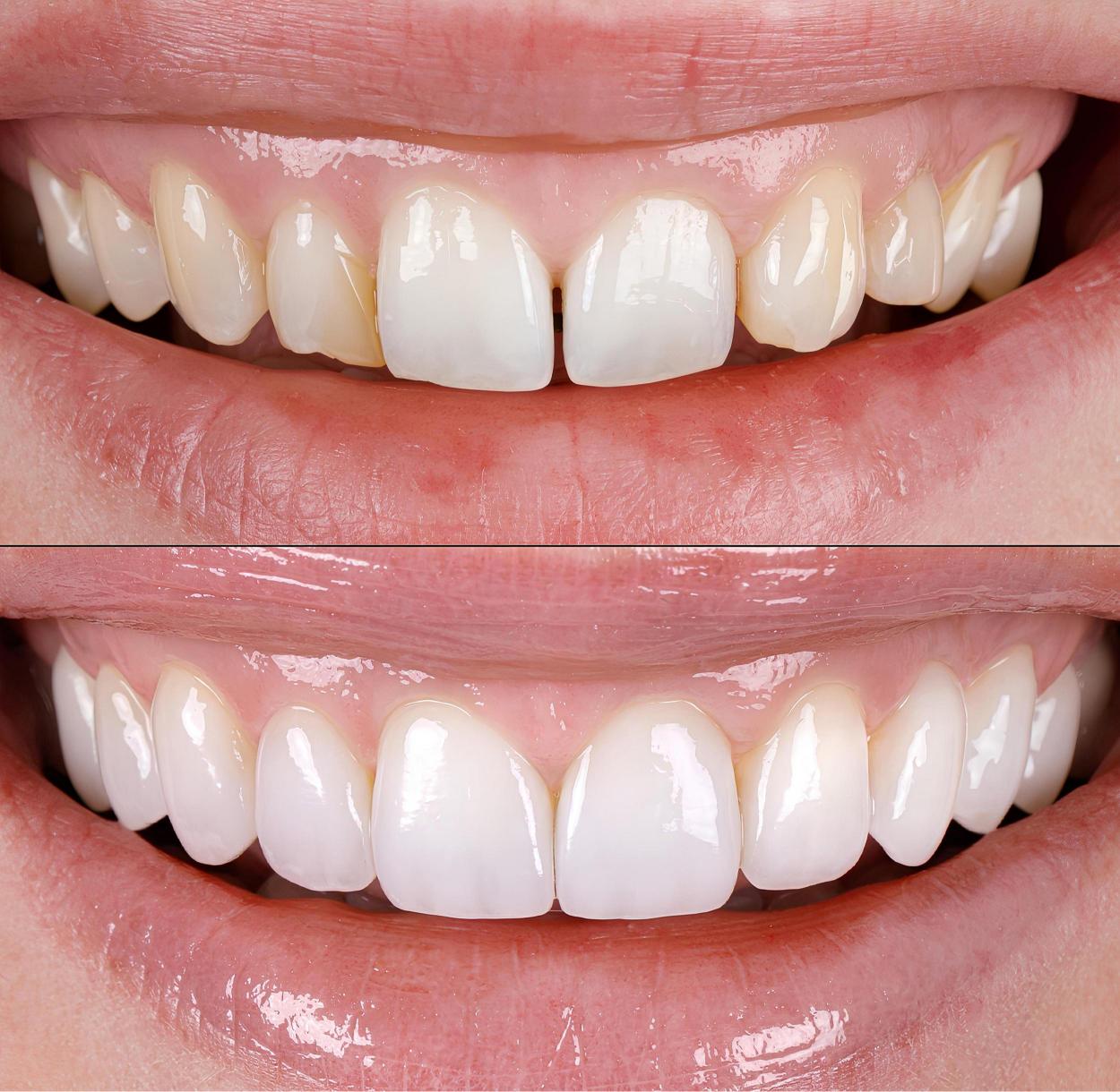 diseño de sonrisa que es y para que sirve
