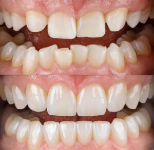 como alinear dientes sin brackets