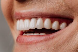 en que consiste poner carillas dentales
