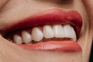 como alinear los dientes sin ortodoncia