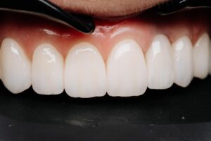 me puedo poner carillas si me faltan dientes
