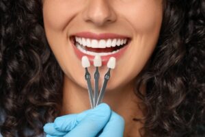 Cuántas carillas se necesitan para una sonrisa perfecta