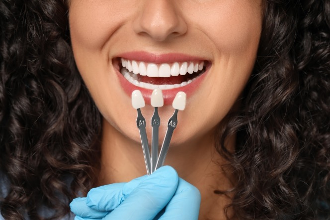 Cuántas carillas se necesitan para una sonrisa perfecta