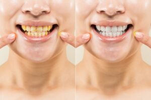 posición correcta de los dientes al cerrar la boca