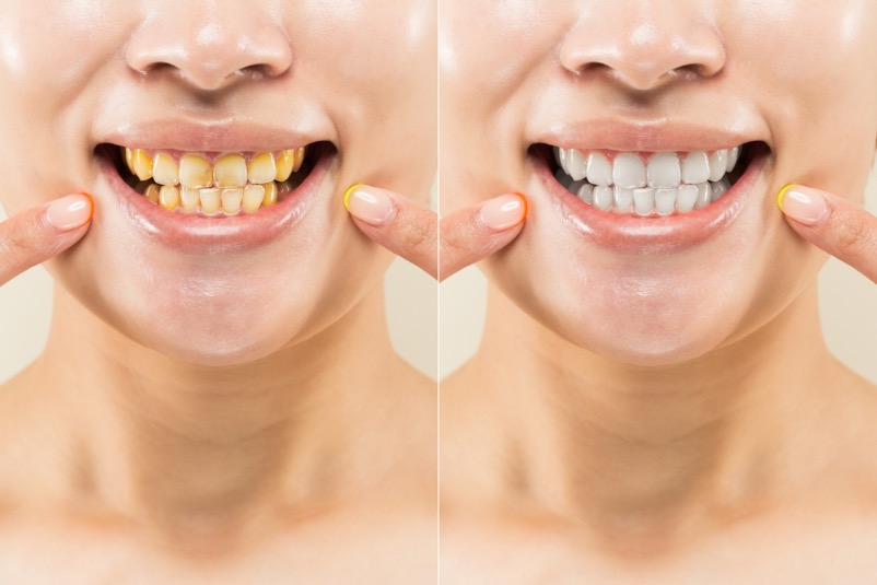 posición correcta de los dientes al cerrar la boca