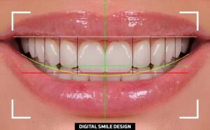 Cómo funciona el diseño de sonrisa digital
