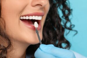 carillas dentales sin limar dientes