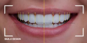 como se hace diseño de sonrisa