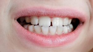 Cerrar huecos entre dientes