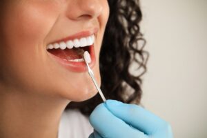 carilla para los dientes