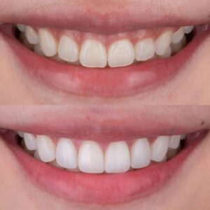 carillas dentales cerca de mí