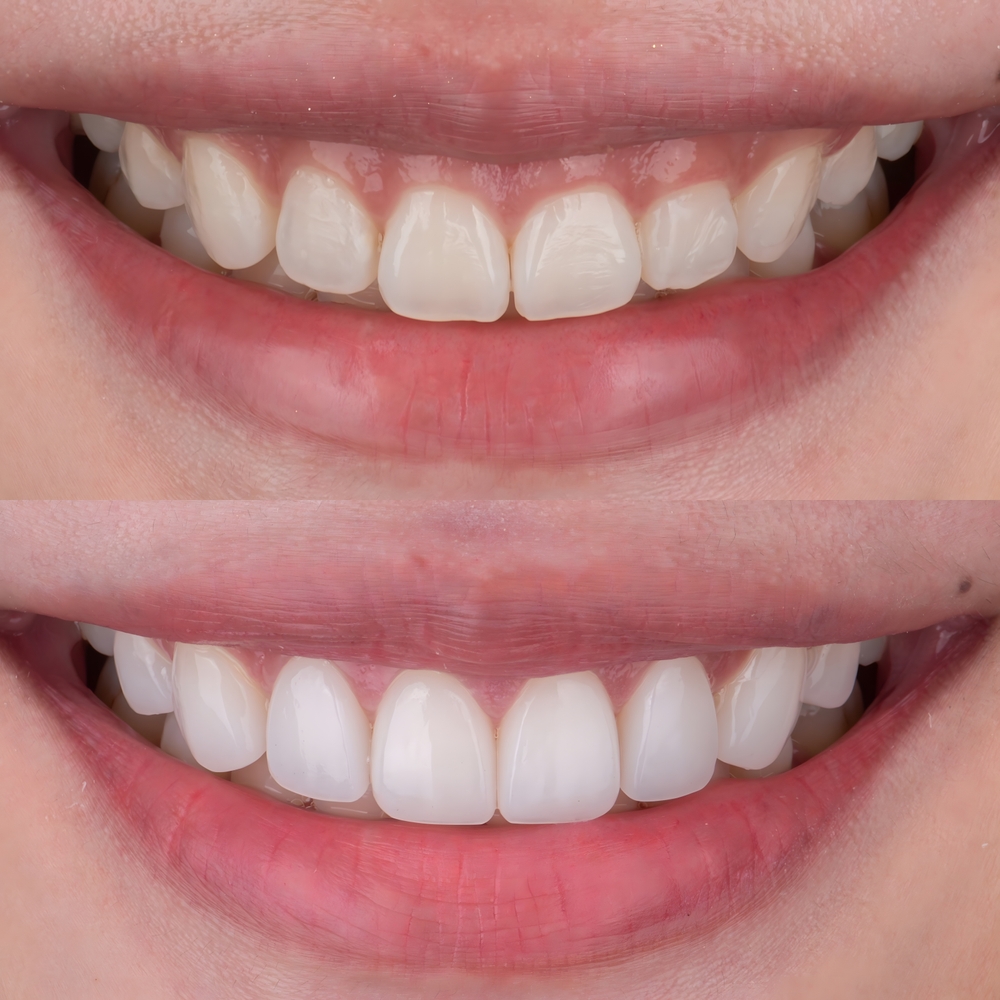 carillas dentales cerca de mí
