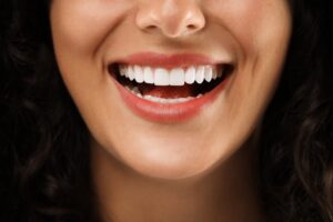 carillas dentales