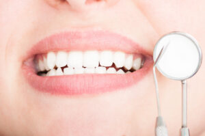 carillas dentales ultrafinas